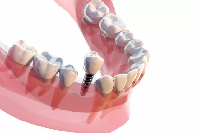 インプラント｜足立区西新井の歯医者・矯正歯科｜さくら参道歯科・矯正歯科